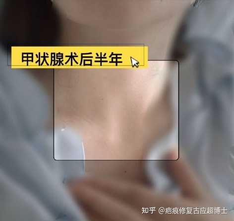 甲状腺手术后一定会留下明显疤痕吗