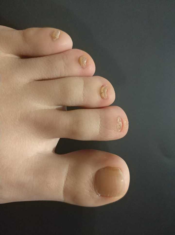 脚指甲为什么会变黄变厚?是灰指甲吗?