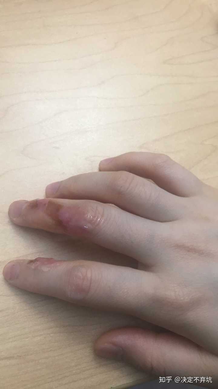 被油烫伤怎么办?