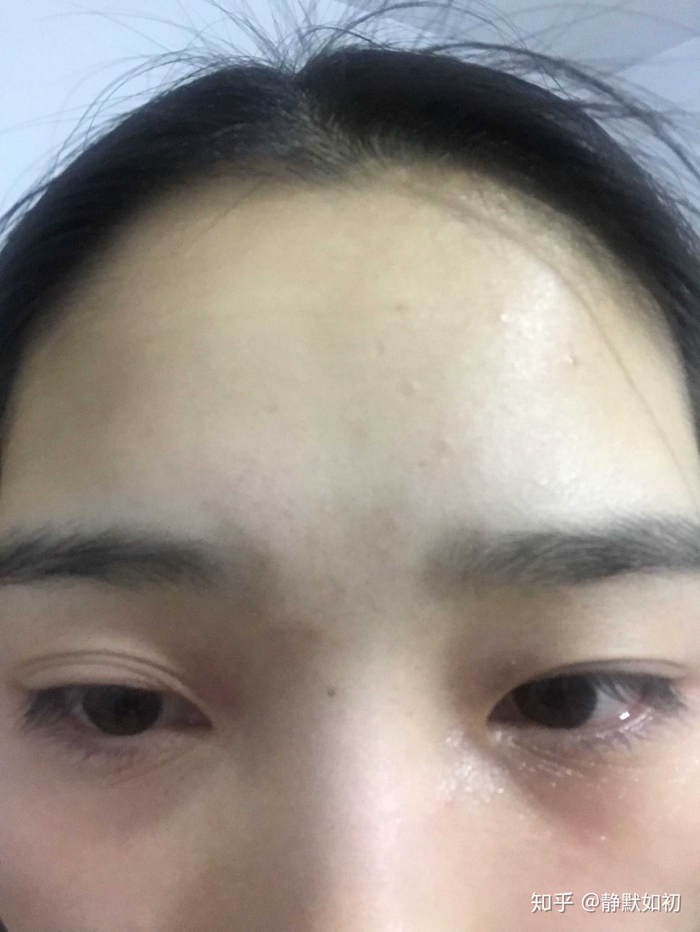 22岁,眼睛下边长了这么多皱纹,半个月前… - 知乎