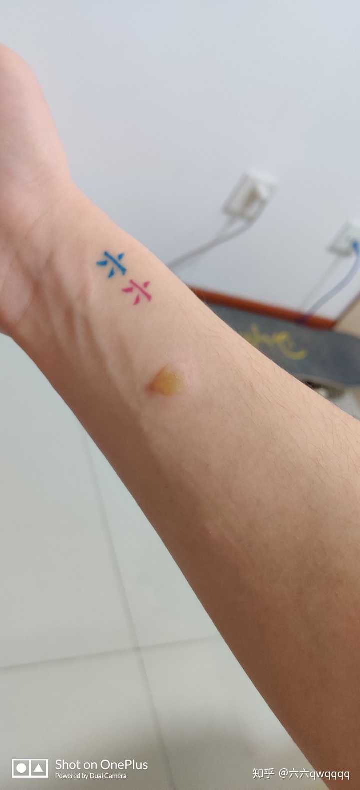 烟头烫在身上是怎样的?