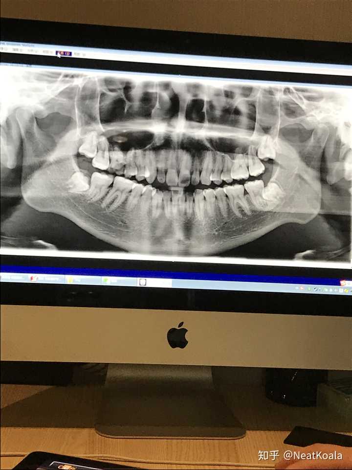 过程:7月14日下午,到牙医诊所,医生通过观察牙齿情况,让我去照个全景