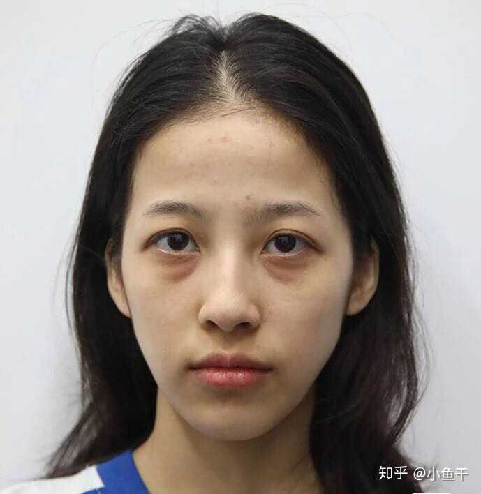 怎样去除下眼袋,去眼袋用什么眼霜好?