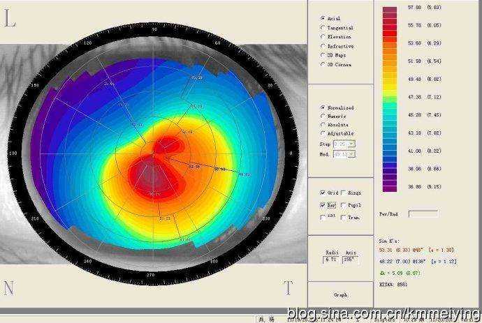 圆锥角膜的角膜地形图呈现