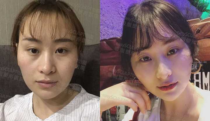 如果只是轻微的颧骨突出可以尝试通过