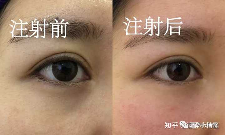 怎么消除泪沟?