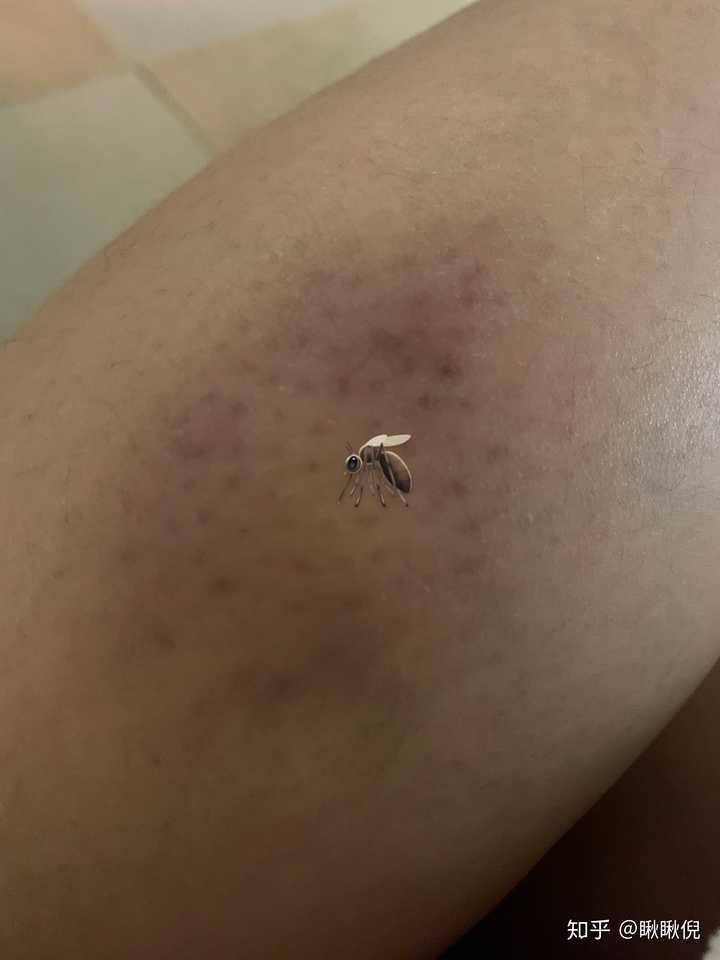 为什么我被蚊子咬了之后皮肤会变成类似淤青的紫红色,消退的很慢,肿的