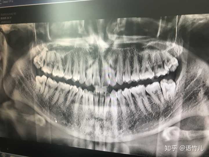 智齿算长得蛮正的,一直体检,牙医都是建议我拔掉,里面有一个龃齿,一直