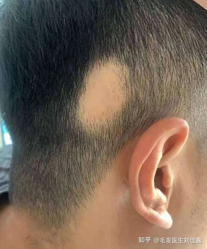 毛发医生刘佳嘉 的想法 斑秃和普通脱发最明显的区别就是斑秃往往