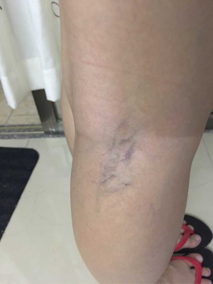 我今年25岁了,我这小腿静脉曲张是吗?能不能治啊?害怕?