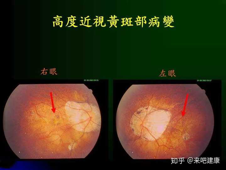 当萎缩累及黄斑时,可出现 黄斑出血,裂孔等病变,视力严重下降,且有