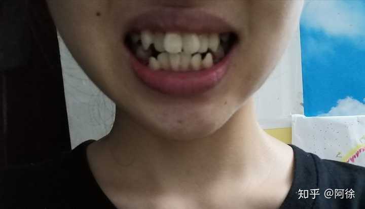 牙不齐,牙关响 牙关错位导致大小脸(我问医生矫齐后牙齿是另一个排列