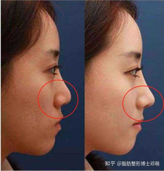 从侧面看,鼻基底凹陷会导致整个面中部