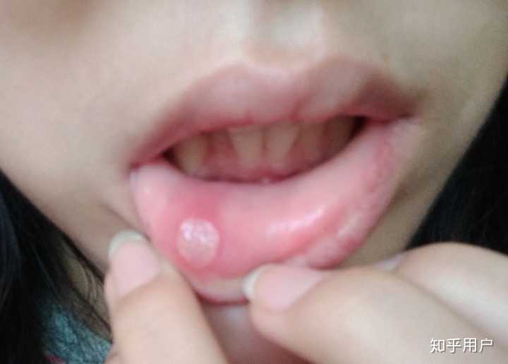 口腔溃疡什么样子 知乎