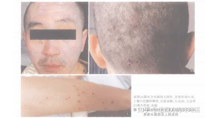 脂溢性皮炎和艾滋病有怎样的关系?