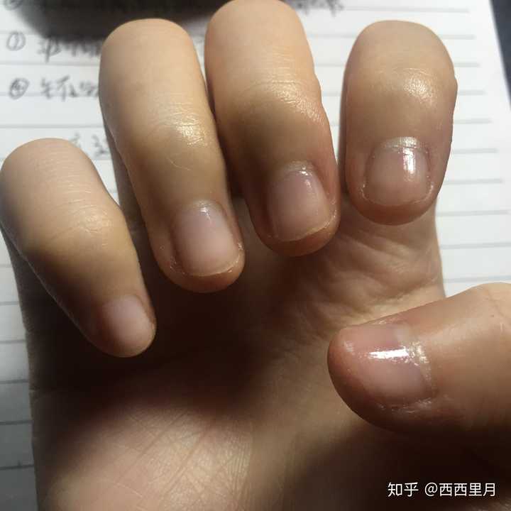 手指甲被咬的超级短怎么办