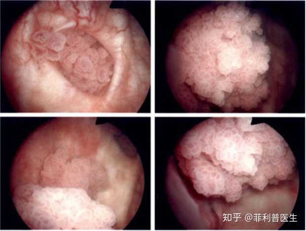 膀胱镜下见到膀胱腔内的菜花样肿瘤