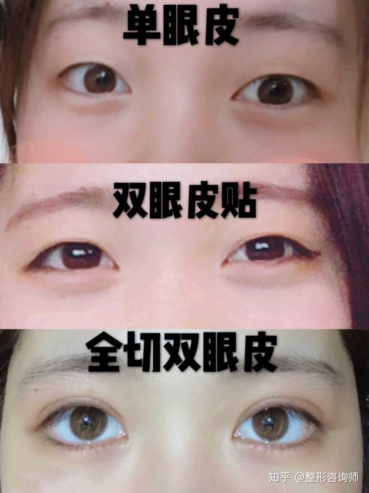 再来直观感受一下单眼皮,双眼皮贴和全切双眼皮的区别吧!