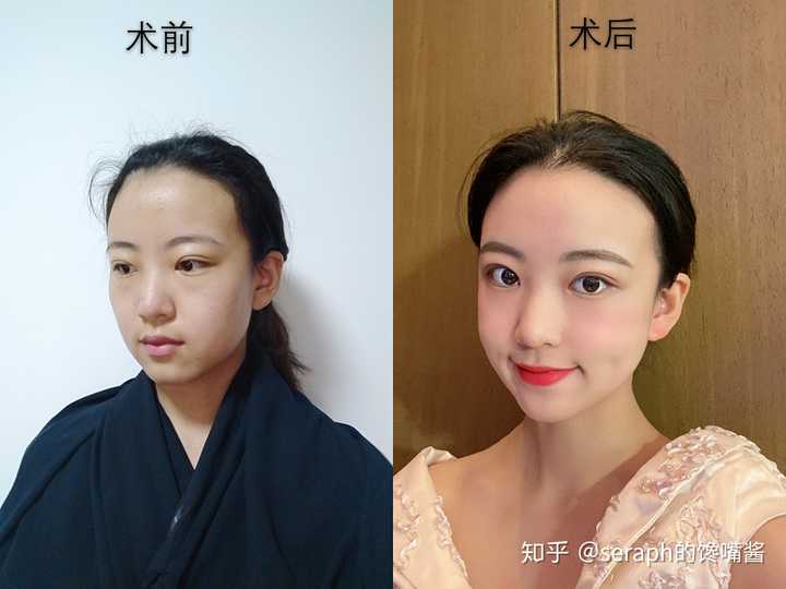 脂肪填充额头,太阳穴