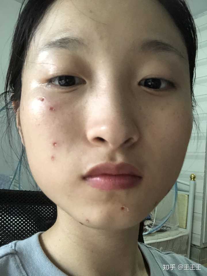 点痣选择何种方式好,有什么注意事项呢?
