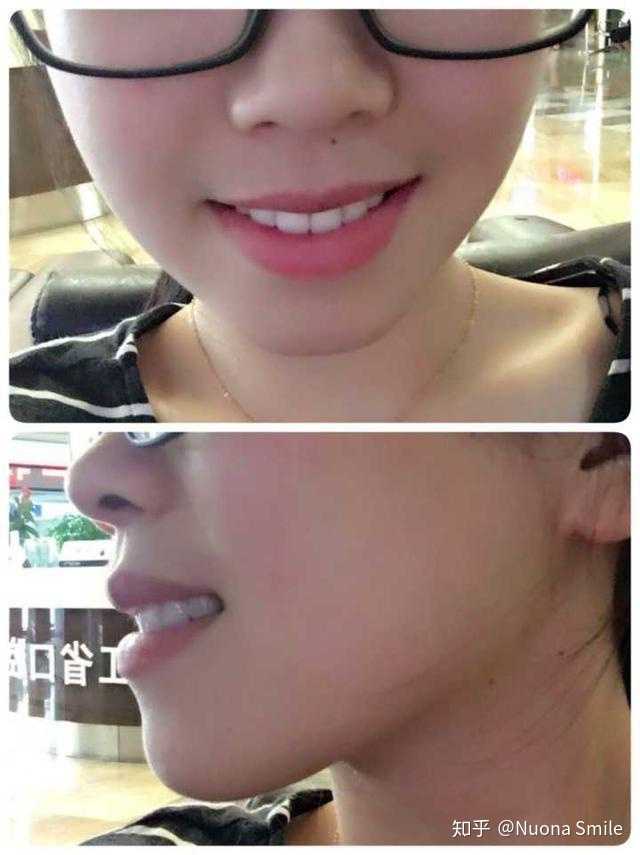 戴过牙套(矫正牙齿)的人脸型变了吗?