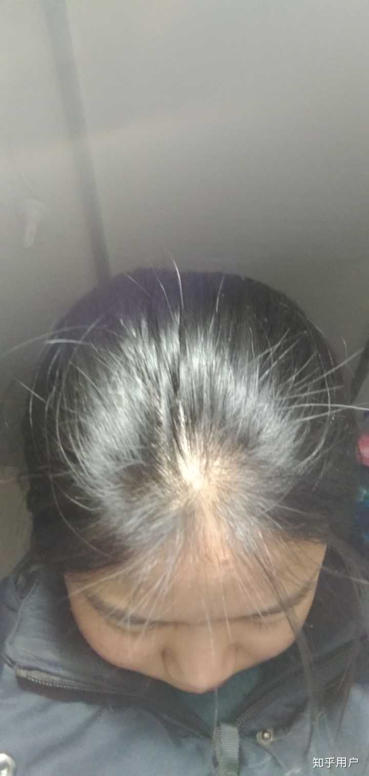 我真是枯辽… 以前没感觉到头发秃的问题,后来到高中就开始在意了
