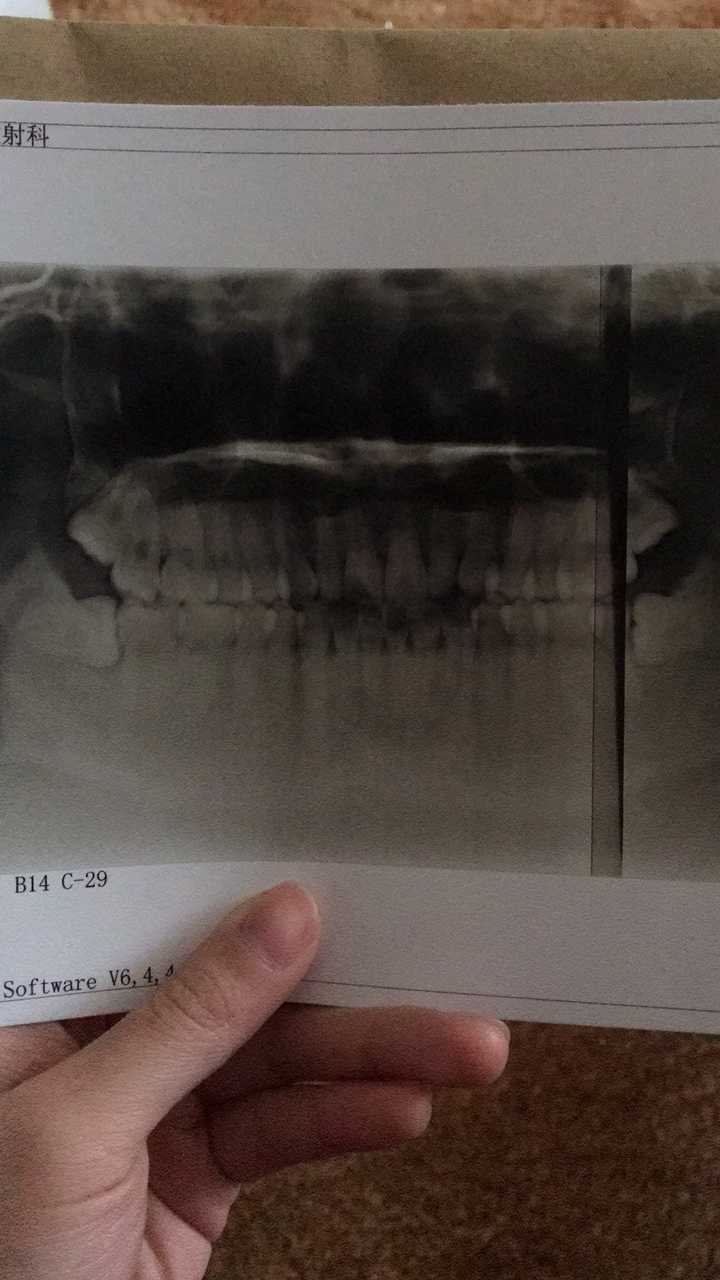 嗯 一下拔了四颗 还有两颗阻生齿 给你们看一下牙片
