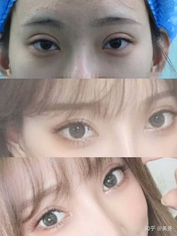 上海双眼皮修复成功