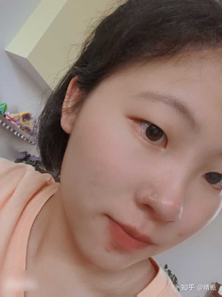 内双 肿眼泡是什么样的感觉?
