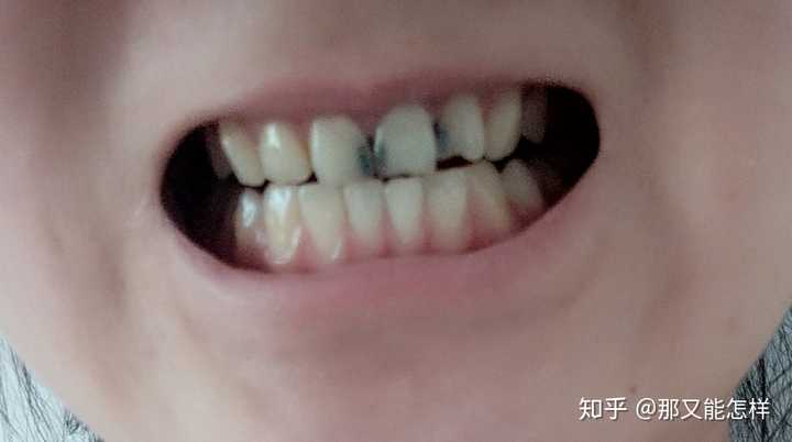 大门牙中间蛀了,医生说要补牙,可是我不知道补牙怎么弄的,特别怕!