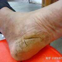 什么是手足皲裂性湿疹