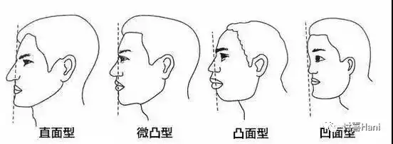 典型的东夷型偏直面型,但受牙齿和下巴发育影响,会变成微凸型