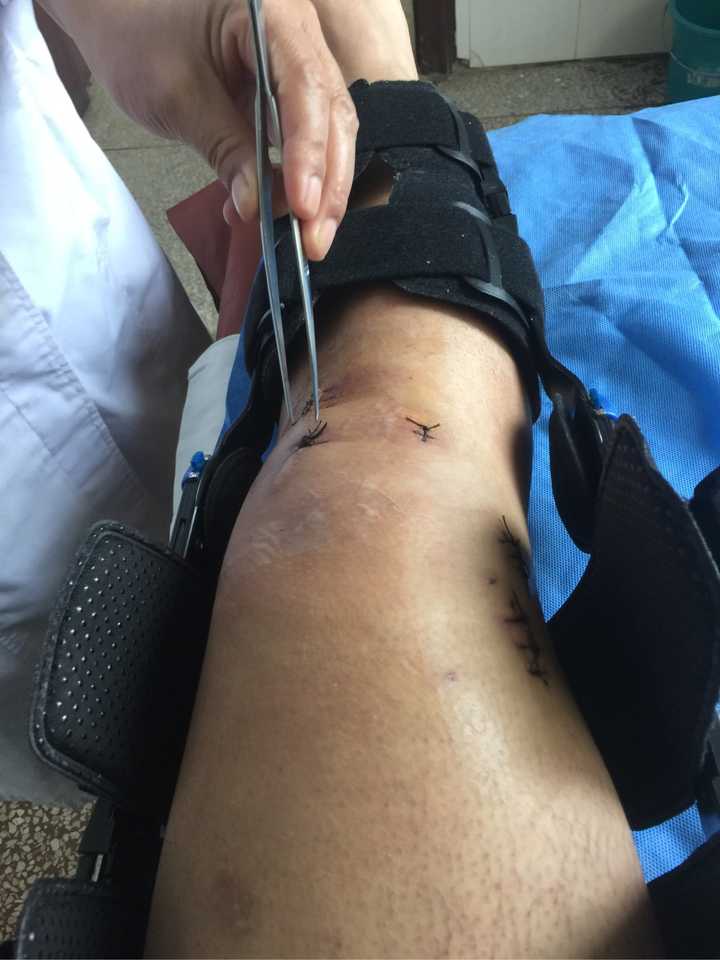 缝针和拆线可怕吗?疼吗?你们当时怕吗?