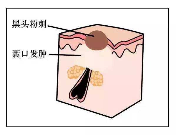 如何去除鼻子上的黑头