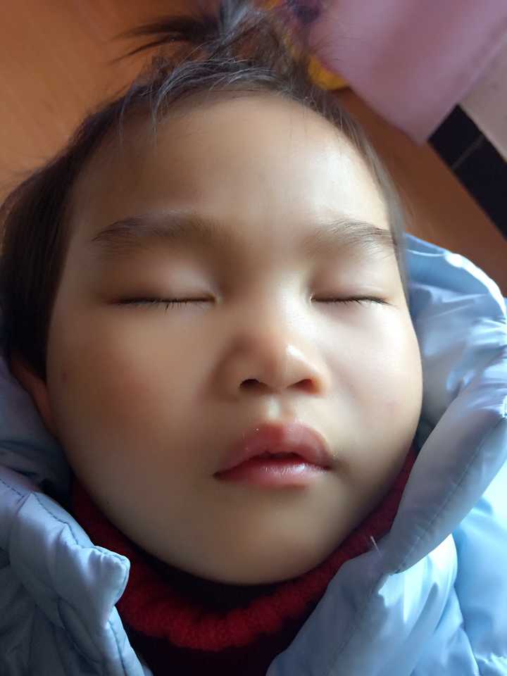 5岁孩子说话时候就撅嘴和笑的时候露过多牙龈,平时会咬下唇,嘴,牙齿深