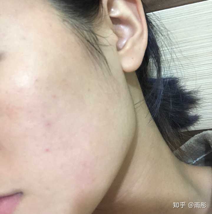 如何改善脸上皮肤特别薄,一直泛红,毛孔粗大,红血丝明显?