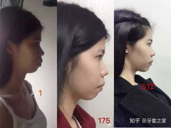 戴牙套可以改善牙齿外凸的程度是多大?(有图)