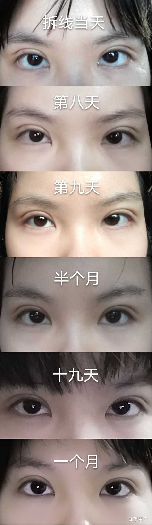 你见过的双眼皮手术最成功,效果最好的案例有哪些?