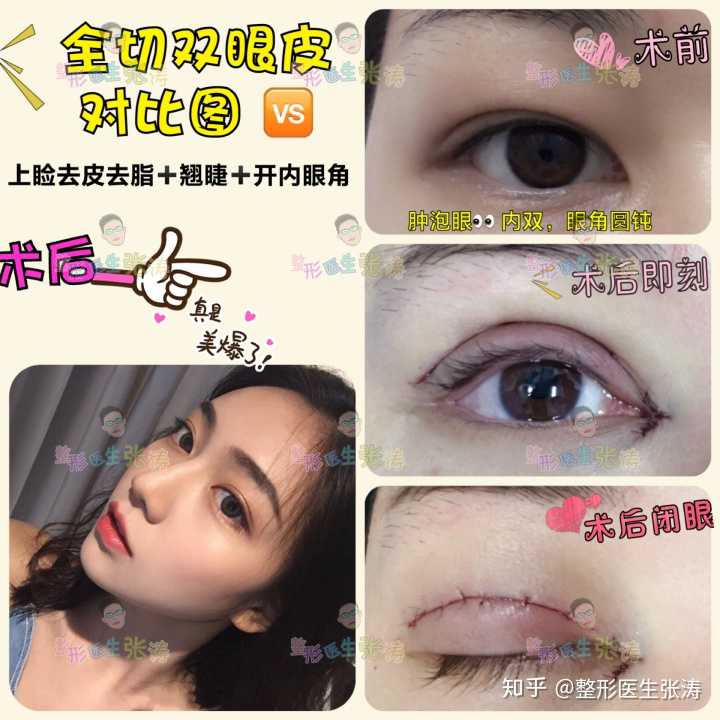 割完双眼皮后还是肿眼泡是怎么回事