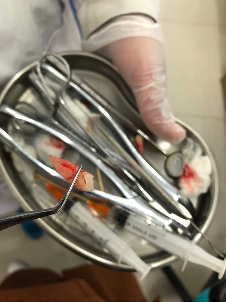 在厦门费用需要多少?推荐整牙的三甲医院有哪些?牙箍要带多久?