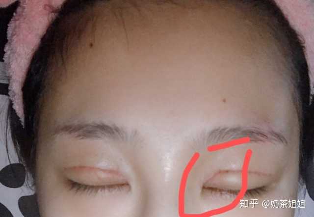 女生要不要割双眼皮呢?