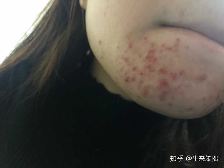 长痘(痤疮)是怎样一种体验?