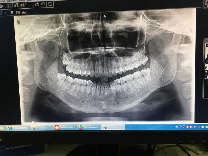拔智齿和拔完智齿是怎样一种体验