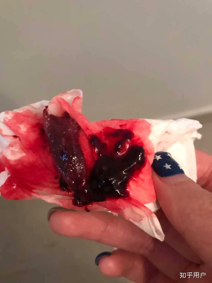 这种一下子掉出来,掉出来之后就不疼了