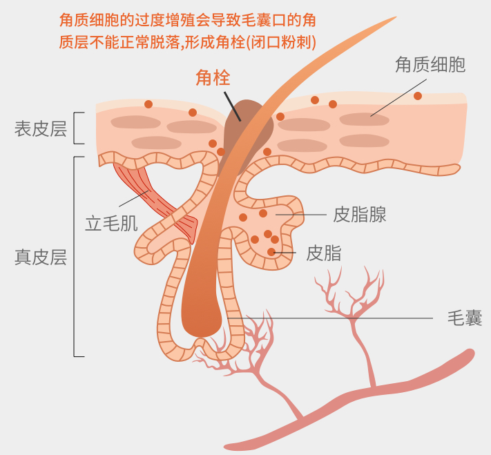 导致毛孔角质栓塞的因素