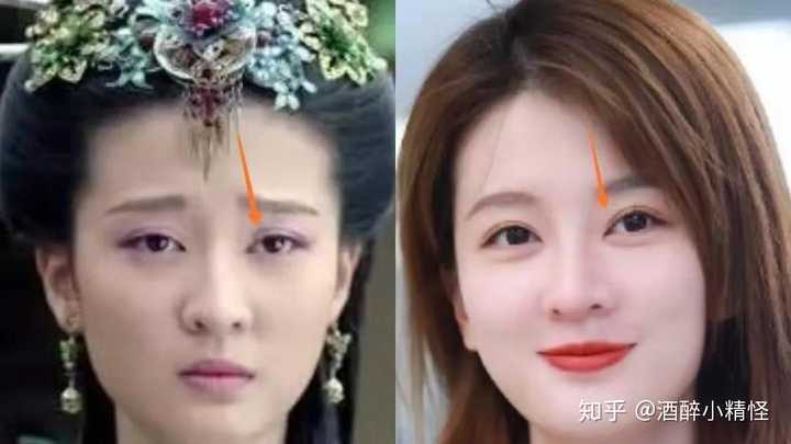 2015vs2019,乔欣眼睛看上去更精神,但同时,由于上睑高度提升,双眼皮褶