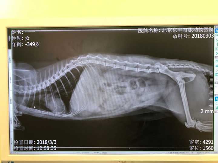 这是去医院拍的x光片,肋骨都包不住长大的肝脏.