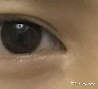 开眼角三年白色凸起疤痕能消除吗?