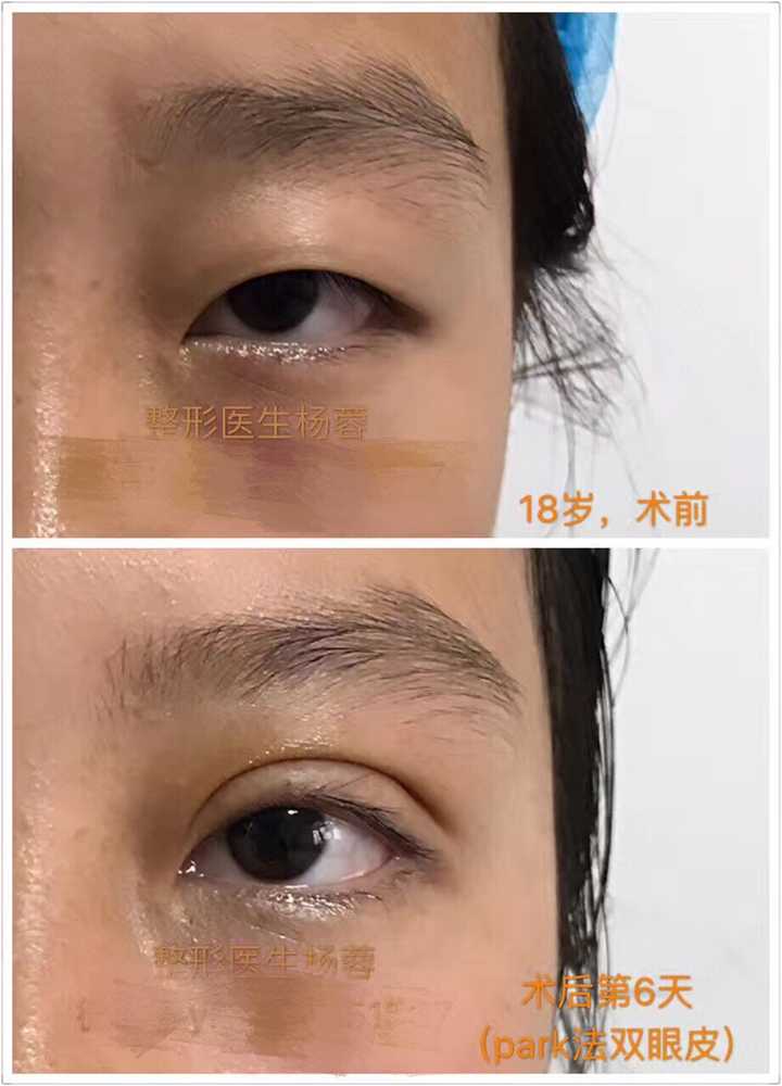 双眼皮松弛怎么办?