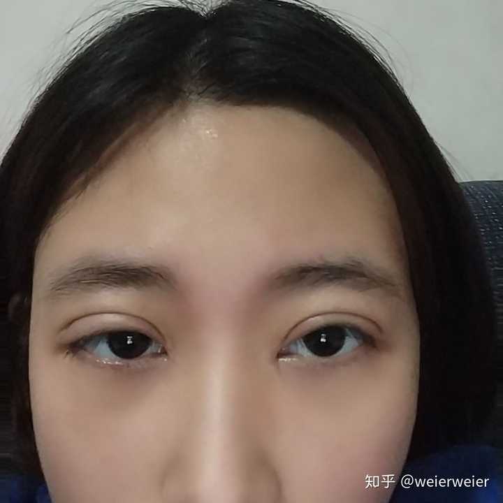 割双眼皮第19天大小不一